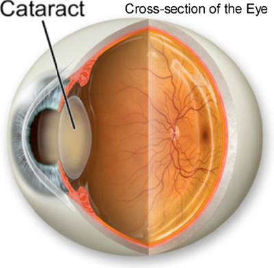 Cataract diagram cross section of the eye-resized-600