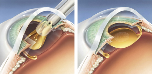 restor-lens-implant